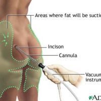 Scăpați de celulită prin liposucție